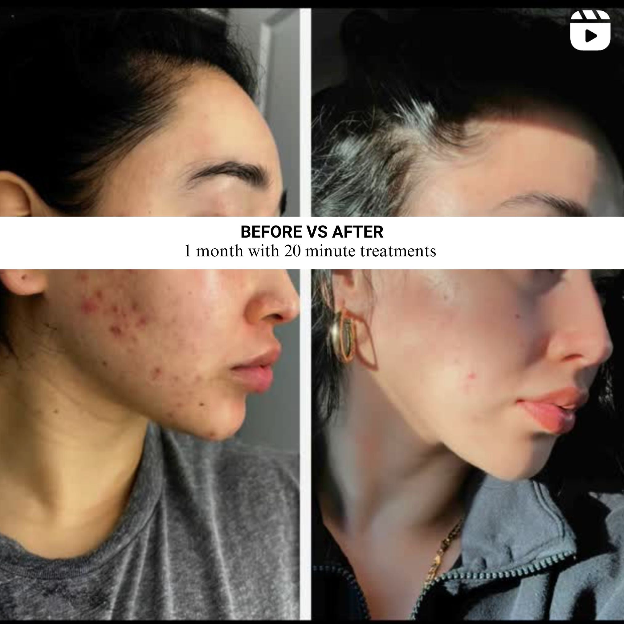 VISO | FDA-Cleared Red Light Therapy Mask | 470 Micro-LEDs | 5x Faster Results