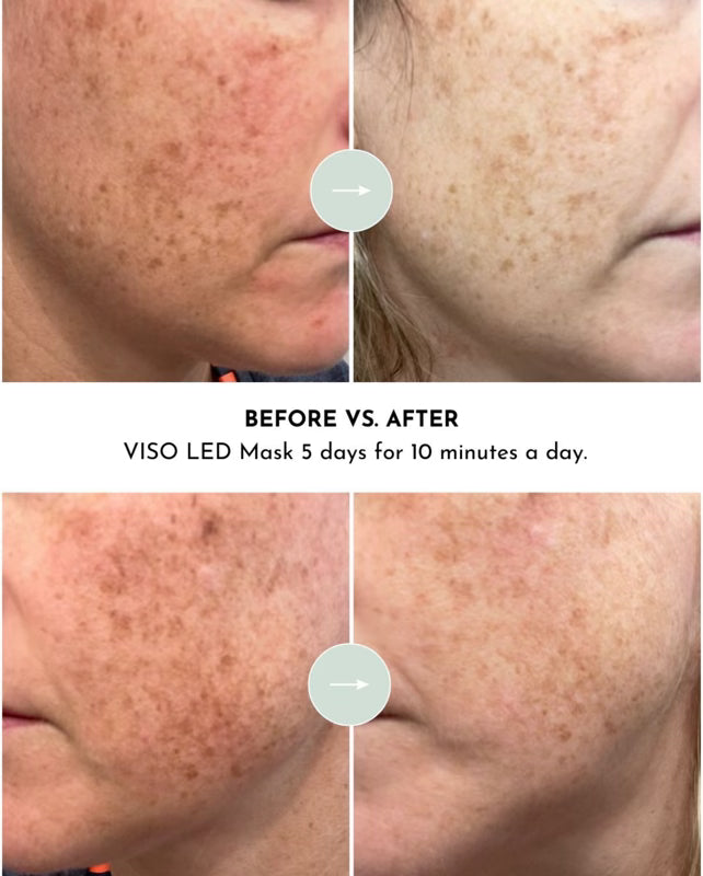 VISO | FDA-Cleared Red Light Therapy Mask | 470 Micro-LEDs | 5x Faster Results